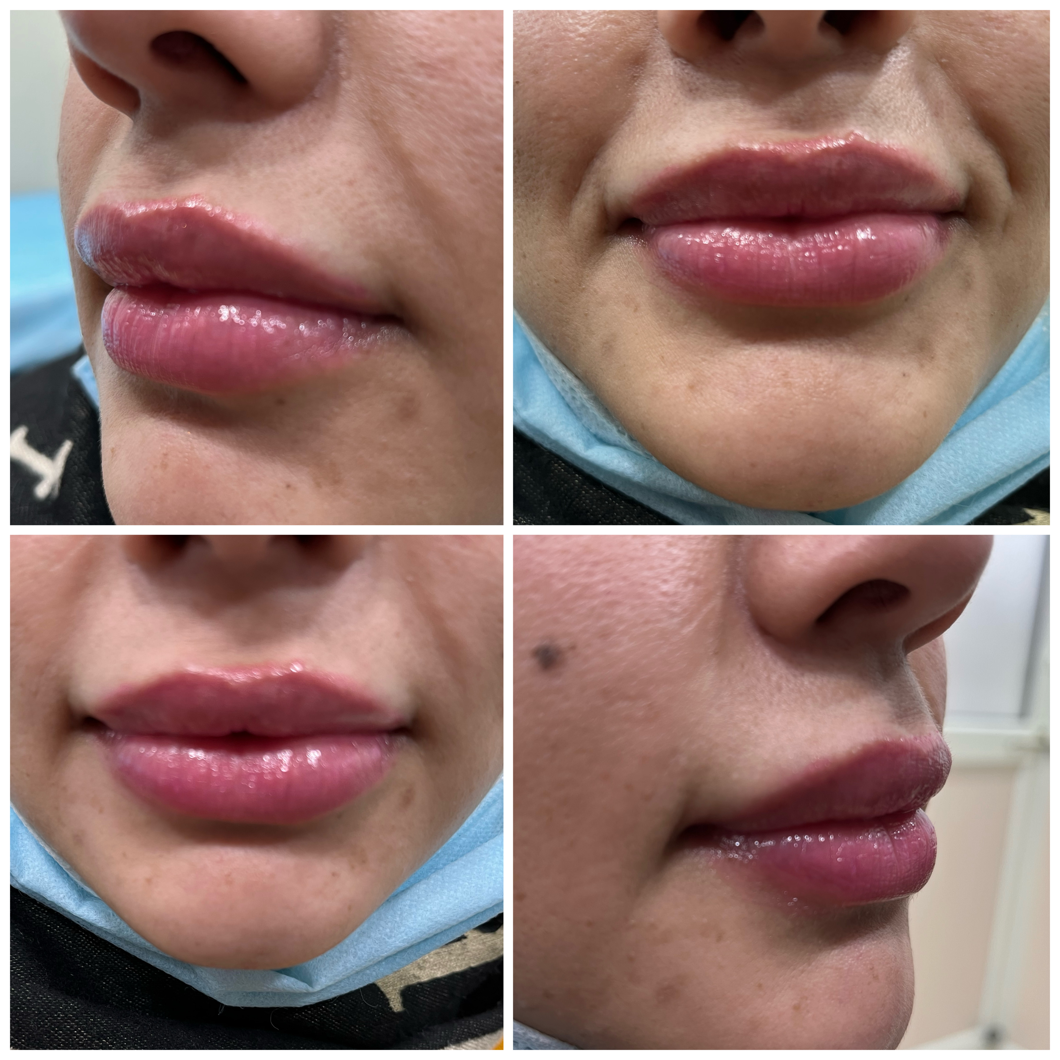 After treatment result