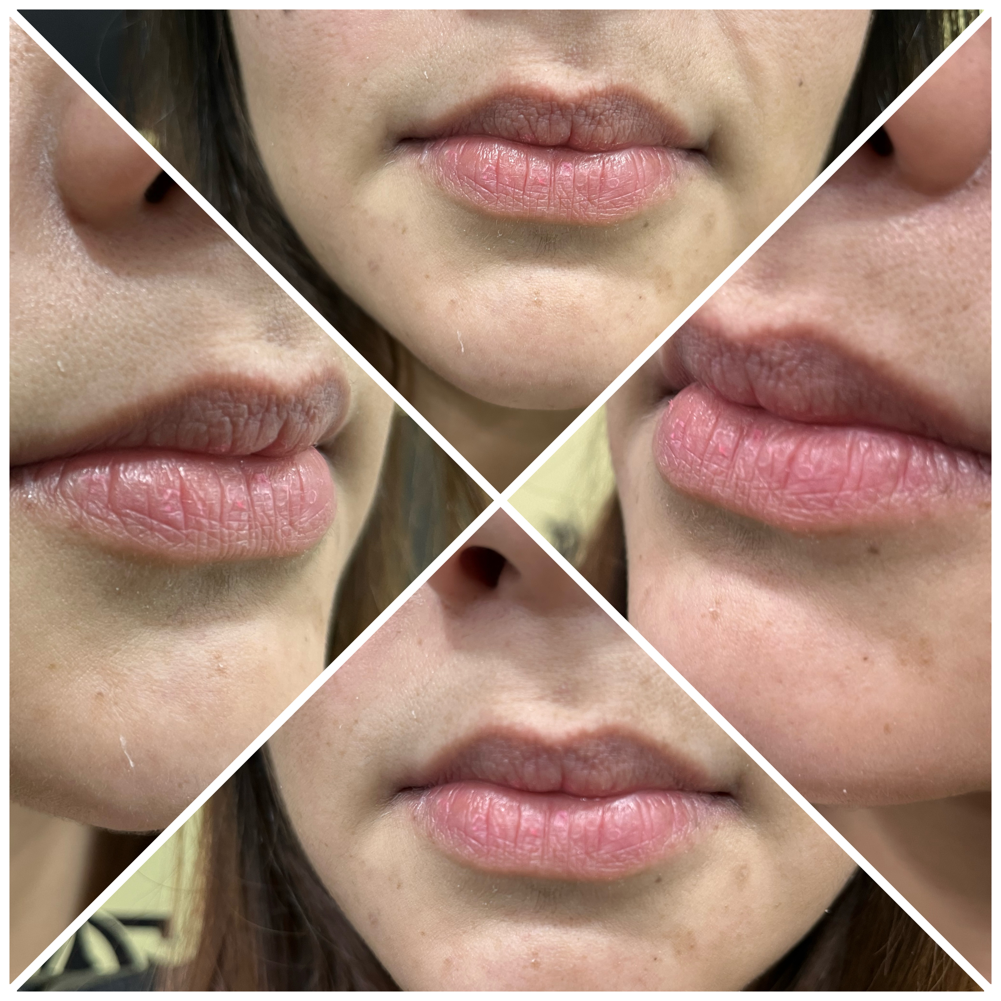 Before treatment result