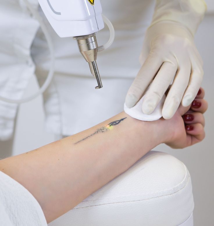 Tattoo removal